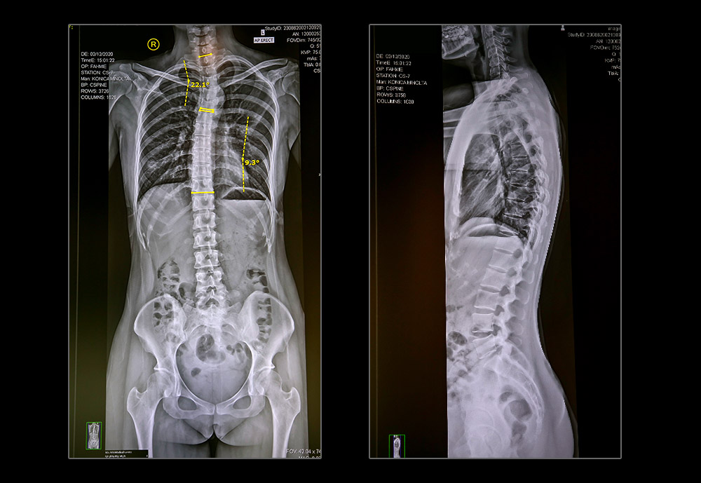 Spinal X-Ray report